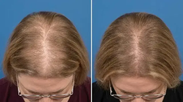 Marilyn T., 62 &mdash; part line, before and after 90 days